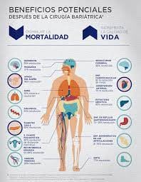 Benficios de la cirugía bariátrica