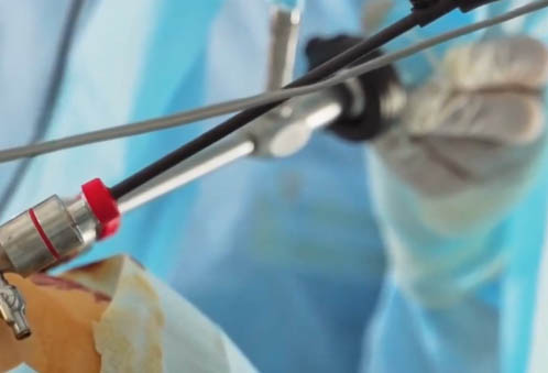 Cómo elige un cirujano barbárico el tipo adecuado de cirugía para cada paciente?