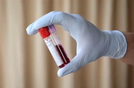 Cómo interpretar tus análisis post-quirúrgicos