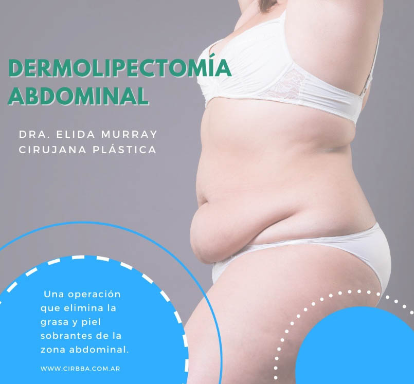 Dermolipectomía abdominal