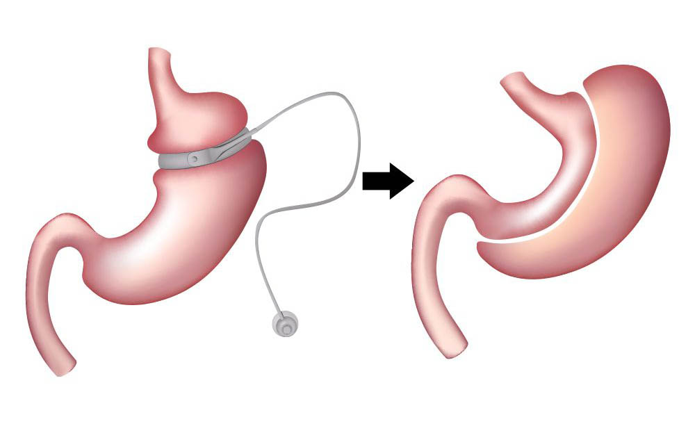 Descubre la importancia de las cirugías de revisión bariátrica. ¿Cuándo y por qué son necesarias?