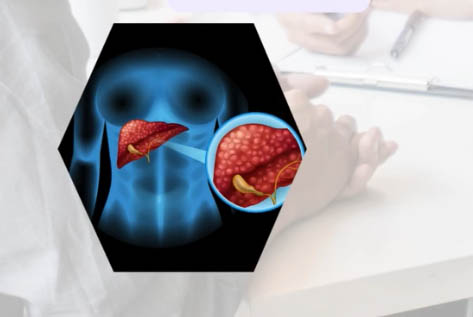 Enfermedad hepática grasa no alcohólica, un tratamiento efectivo